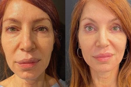 Blepharoplasty: The Eyelid Lifting Procedure Is on the Rise — But Is it Safe?