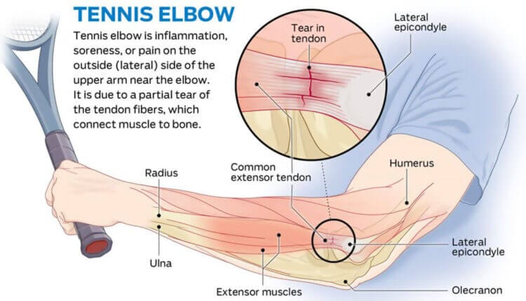 How To Get Rid Of Tennis Elbow F