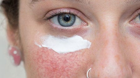 STEP-BY-STEP GUIDE TO EYELID DERMATITIS TREATMENT – Delfina Skin™