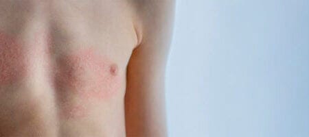Best Oil For Eczema – Delfina Skin™