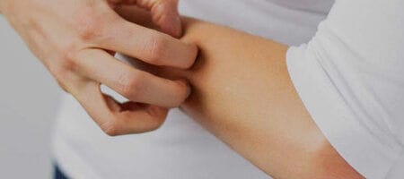 Home Remedies For Eczema – Delfina Skin™