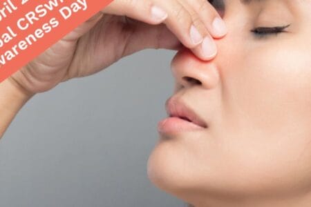 Nasal polyps 101